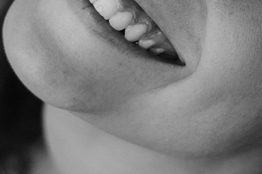 Filler behandelingen - mondhoeken