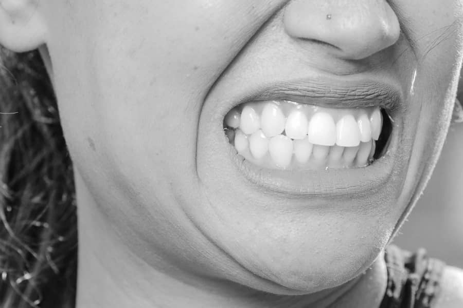 Botox behandelingen - tandenknarsen